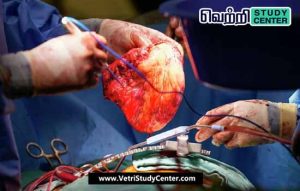 Vetri Study Center Current Affairs - Heart Transplant